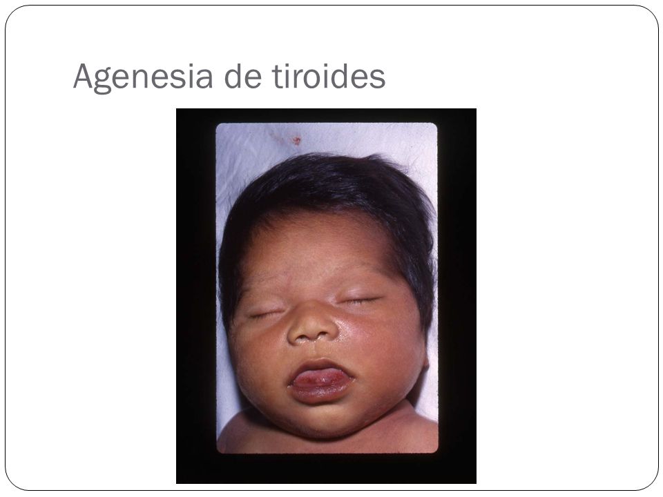 agenesia parcial de tiroides